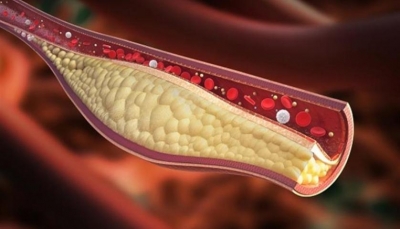 علامات على القدمين تشير لارتفاع نسبة الكوليسترول في الدم